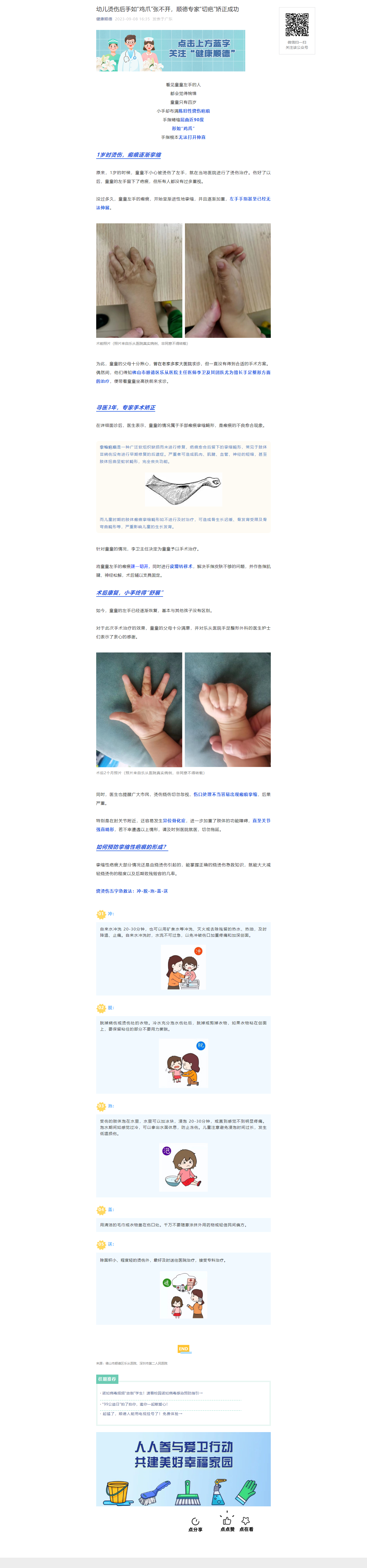 幼儿烫伤后手如“鸡爪”张不开，顺德专家“切疤”矫正成功.png