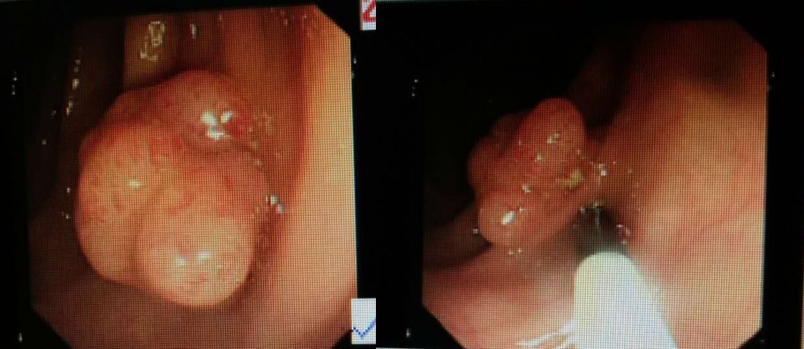 大肠息肉，你肚子里的定时炸弹！切除了也要复查！