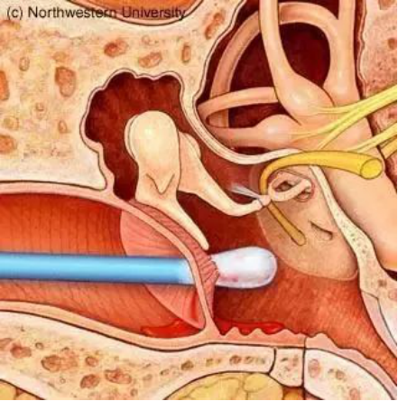 喜欢掏耳朵，危险你知道多少？