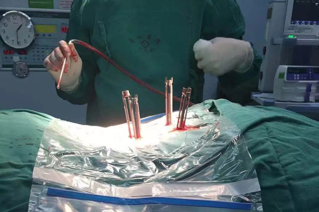 福音 ▏脊柱微创精准技术治疗椎体骨折