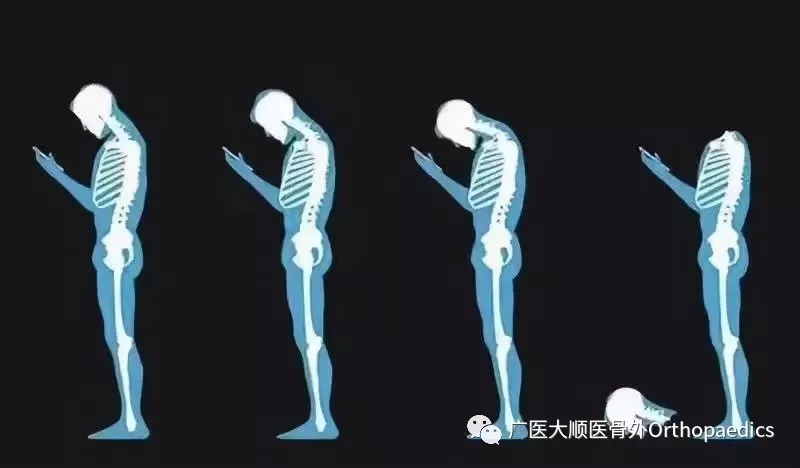 【科普】美女，你的“绝味鸭脖”掉啦，医生喊你呢！