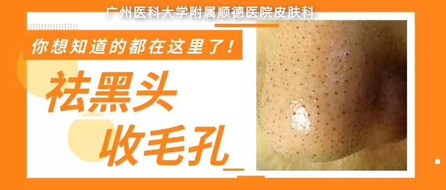【科普】祛黑头，收毛孔？你想知道的，都在这里了！