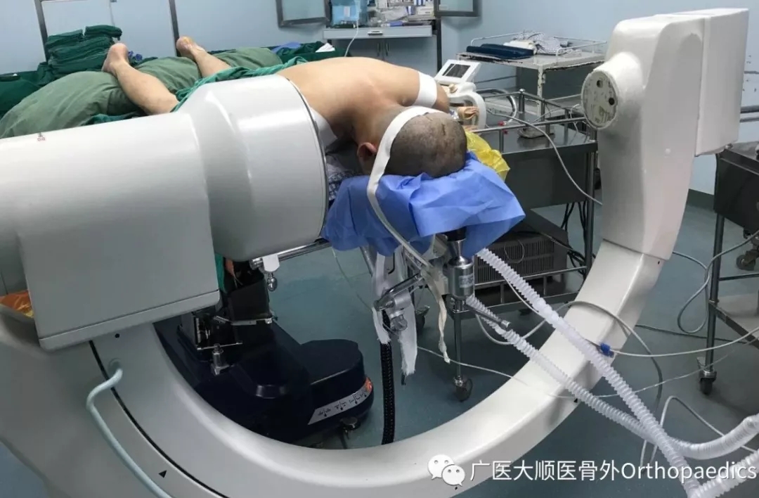 上帝关上一扇窗的同时会打开一扇门——无骨折脱位型颈髓损伤