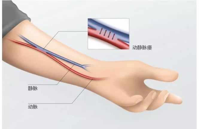 【福音】这款救命神器再立一功， 首例 DSA下动静脉内瘘狭窄球囊扩张术顺利开展！