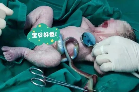 惊险！B超查出胎儿脐动脉栓塞，多学科出击保母子平安