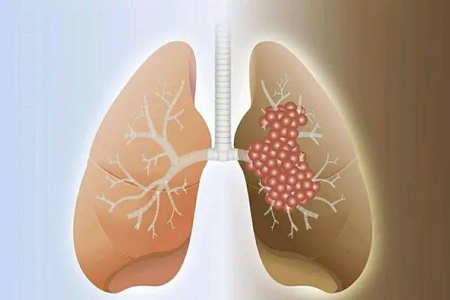 “肺”同小可，可怕的小细胞肺癌，真是不治之症？